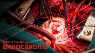 Signs and Symptoms of Endocarditis Mnemonic [upl. by Naresh]