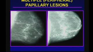 Management of Papillary Breast Lesions [upl. by Adnolahs]