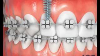 Desensitizing Procedure using the NEW TEETHMATE DESENSITIZER from Kuraray [upl. by Lapotin4]