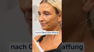 oberlidstraffung lidkorrektur lid straffung antiage düsseldorf plastischechirurgie [upl. by Edythe874]