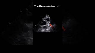 The Great Cardiac vein in echocardiography echocardiography heartartery echocardiographer [upl. by Leopoldeen921]