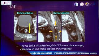 Lung ablation [upl. by Lane]