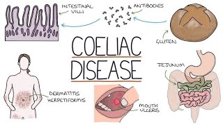 Celiac Disease Symptoms Diagnosis and Treatment CeliacDisease MedicalStudents Gastroenterology [upl. by Seka267]