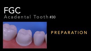 Full Gold Crown Preparation  30 Acadental Tooth [upl. by Andert]