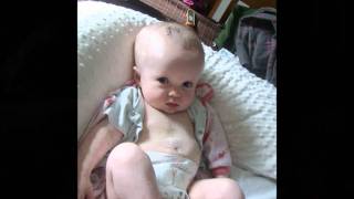 HYDROCELPHALUSmy story [upl. by Trish528]