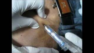 How To Give Goserelin Injection By Subcutaneous Mode [upl. by Sorrows]