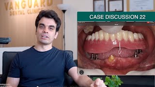 Denture on Implants  Case Discussion 22 [upl. by Gerda]