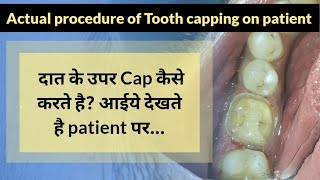 आईए देखते है Tooth Capping कैसे करते है l Tooth Capping Procedure on patient [upl. by Enner88]