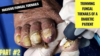 Massive Fungal Toenails  Trimming Fungal Toenails of a Diabetic Patient  Part 2 Podiatry [upl. by Walker]