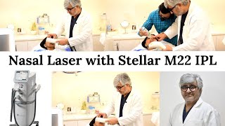 Nasal Laser with Stellar M22 IPL  Advanced wellness [upl. by Menzies397]