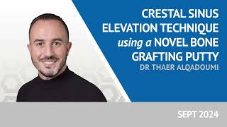 Crestal Sinus Elevation Using a Novel Bone Grafting Putty with Dr Thaer Alqadoumi [upl. by Yajiv258]