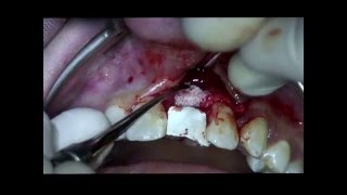 Step 4 Straumann BLT implant Placement Bone Augmentation and Suturing in the anterior maxila [upl. by Leffert]