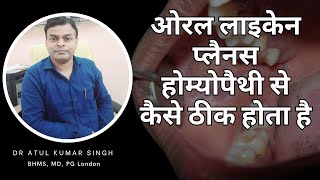 मुंह के लाइकेन प्लेनस का होम्योपैथी से इलाज  मरीज़ की जुबानी  Lichen planus homeopathic treatment [upl. by Harwill]