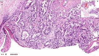 Adenocarcinoma of the Esophagus  Histopathology [upl. by Alorac]