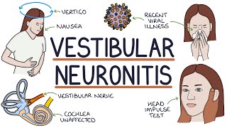 Understanding Vestibular Neuronitis [upl. by Wash]