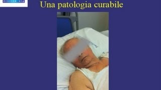 Diagnosi e trattamento Idrocefalo Normoteso  caso clinico [upl. by Gracye]