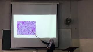 CNSpathologylecture9part2oligodendroglioma [upl. by Llennaj180]