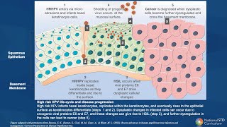 STD Lecture Series Human Papillomavirus HPV [upl. by Garvey902]