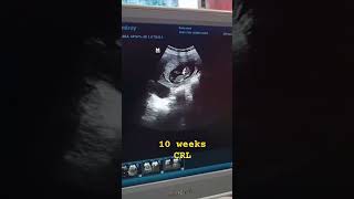 10 weeks CRLultrasound doctordoctors health hospitalpregnancy pregnant baby babygirl [upl. by Kursh979]