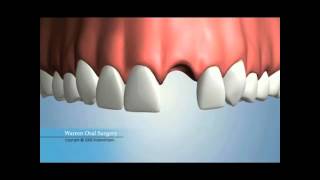 Single Missing Tooth Replacement Options [upl. by Kosey]