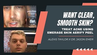 WANT CLEAR SMOOTH SKIN TREAT ACNE USING EMERAGE SKIN AERIFY PEEL  ALEXIS TAYLOR x DR JASON EMER [upl. by Sallyanne582]