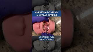 Anestesia Nervo alveolar inferior [upl. by Nayb]