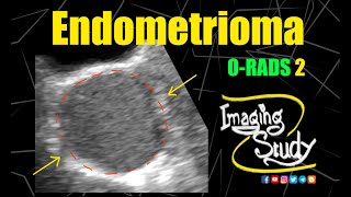 Endometrioma  Chocolate Cyst  ORADS US 2  Ultrasound  Case 298 [upl. by Burgwell]