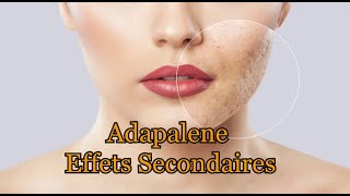 Adapalene Effets secondaires [upl. by Mcnamee996]