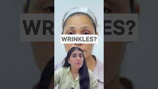 Wrinkles  How to get rid of forehead wrinkles Botox Botox treatment for face skincare wrinkles [upl. by Evol203]