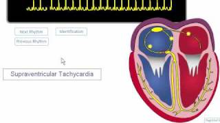 ECG Rhythm Review SVT Atrial Fibrillation Atrial Flutter [upl. by Ayatnahs]