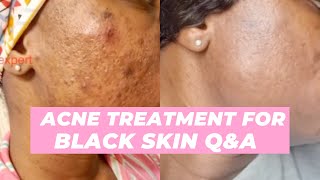 QampA How to Get Rid of Pimples Black Skin [upl. by Ihcas]