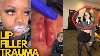 EXPOSING the DANGERS of TIKTOK LIP FILLER TECHS [upl. by Adlesirc]