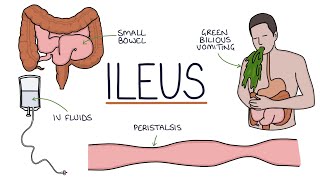 Understanding Ileus Paralytic Ileus [upl. by Atok]