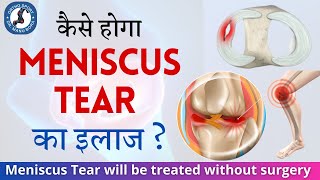 कैसे होगा Meniscus Tear का इलाज  Meniscus Tear Treatment without surgery Meniscus Repair Trim [upl. by Aneeuqahs]