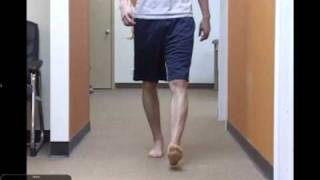 Clinical Gait Case Study Tibial Varum with Postop ACL complications [upl. by Philip]