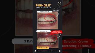 Addressing Gum Recession amp Crown Length with Pinhole® pinhole gumrecession gumrestoration [upl. by Manville449]