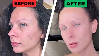 How to Fix Hyperpigmentation amp Dark Spots  FAST amp Inexpensive [upl. by Eerdna]