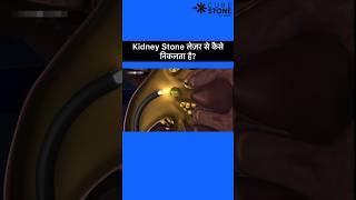 Kidney stone laser treatment  Retrograde Intrarenal Surgery  Rirs shorts [upl. by Acsirp]