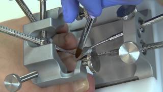 Podoexpert  Lesson4  Small Toenail Improperly Clipped [upl. by Eiluj]