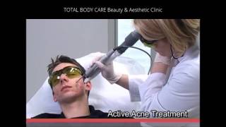 Active Acne and Acne Scarring Laser Treatment at Total Body Care Clinic [upl. by Emalee556]