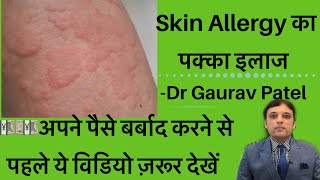 स्किन ऐलर्जी का इलाज।Skin Allergy Treatment At Home By Dermatologist Dr Gaurav Patel skinallergy [upl. by Dewie87]