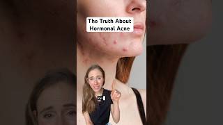 Hormonal Acne Is A Mixed Bag  Heres What You Need To Know dermatologist [upl. by Ardekal]