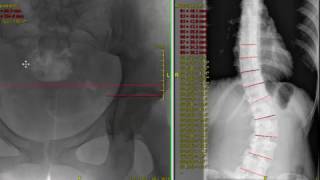 Scoliosis from Leg Length Inequality  seen on xray [upl. by Dennard]