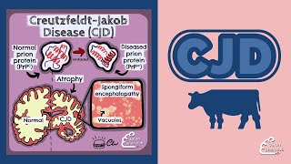 Creutzfeldt Jakob Disease CJD [upl. by Etsirk445]