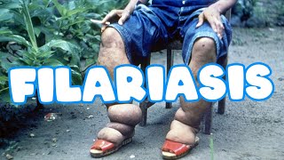 Filariasis  Elephantiasis  wuchereria bancrofti  Life cycle  clinical features  Lab diagnosis [upl. by Noman]