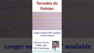 Torsades de Pointes [upl. by Edya4]