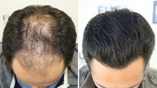 Injerto Capilar FUE 3584 Injertos  Alopecia NW V Dr Couto  FUEXPERT CLINIC  Recuperar Pelo [upl. by Ynnad]