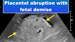 Placental abruption with fetal demise I Ultrasound [upl. by Lemhaj]