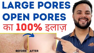 Open Pores Large Pores Clogged Pores Permanent Treatment [upl. by Nagud334]