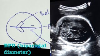 BPD biparietal diameter measurements and landmarks [upl. by Winikka]